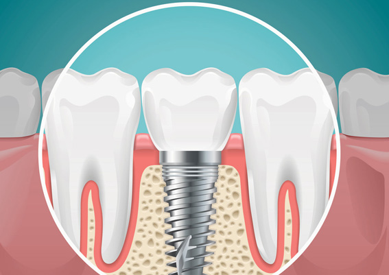 implantes osteointegrados