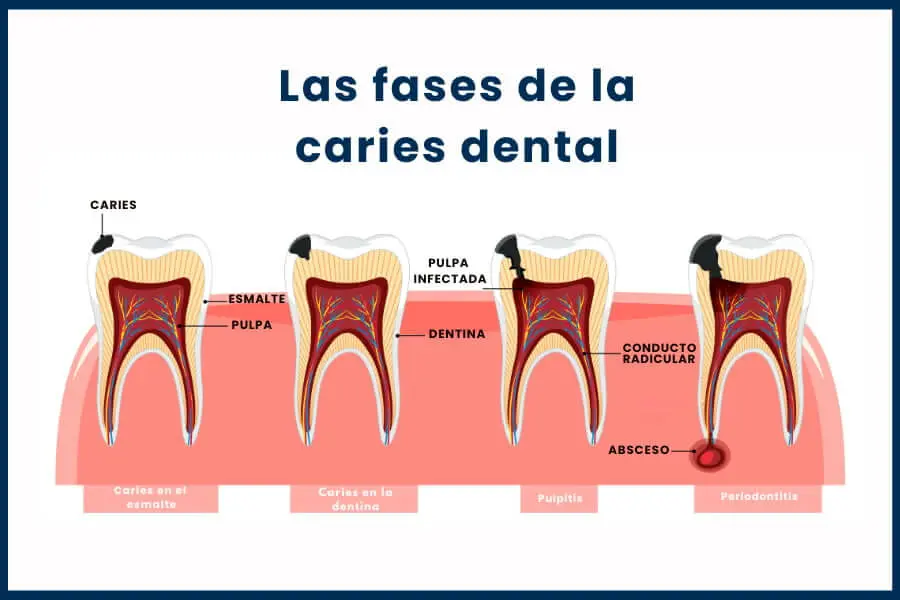 Caries dental causas sintomas y tratamiento en Guadalajara