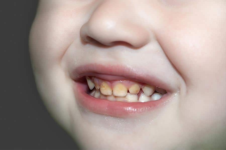 Dientes amarillos en niños